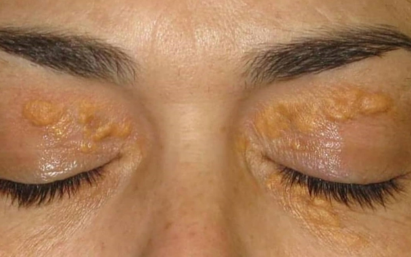 Mí mắt có ban vàng - Dấu hiệu rối loạn lipid máu