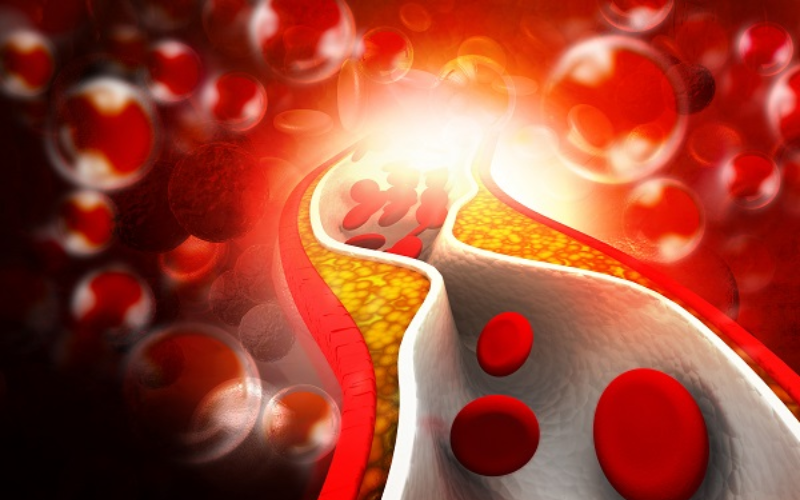 Rối loạn lipid máu là tình trạng mất cân bằng thành phần chất béo trong máu