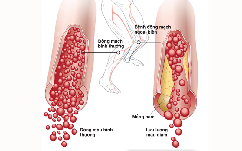 Bệnh động mạch ngoại biên - Biến chứng của rối loạn lipid máu