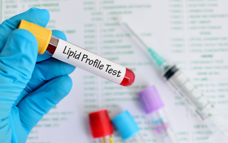 Triệu chứng rối loạn lipid máu thường bị bỏ qua - Nên xét nghiệm máu định kỳ