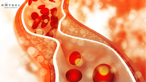 Rối loạn lipid máu: Hiểu đúng để sống khỏe
