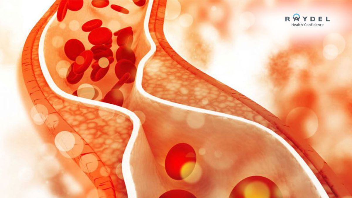 Rối loạn lipid máu là gì? Nguyên nhân, triệu chứng và cách điều trị