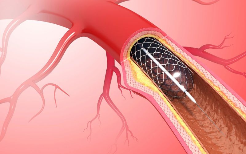 Can thiệp động mạch vành qua da