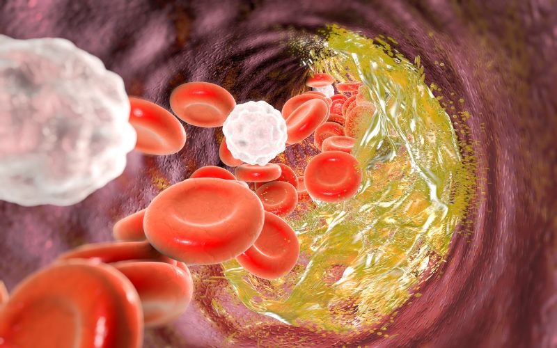 Cholesterol xấu được dùng để chỉ LDL thành phần cholesterol tích tụ và gây tắc nghẽn mạch máu