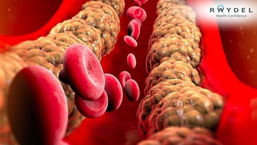 Cholesterol Xấu là gì? Phân biệt Cholesterol Tốt và Xấu