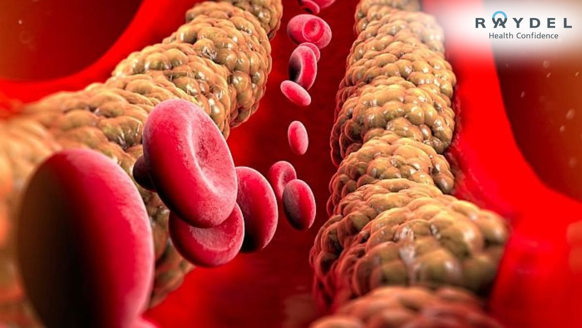 Cholesterol Xấu là gì? Phân biệt Cholesterol Tốt và Xấu