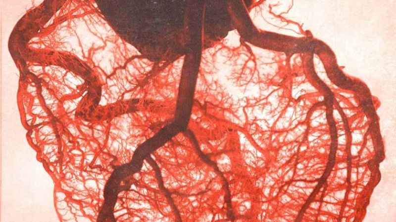 Đau thắt ngực vi mạch máu