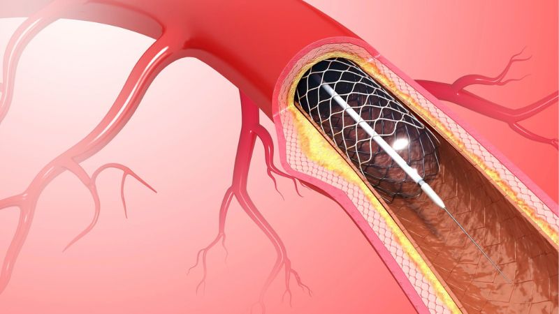 Đặt stent mạch vành