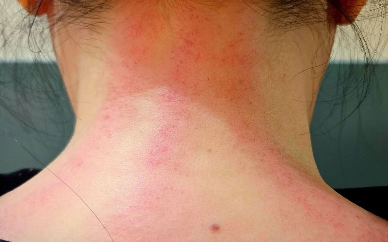 KHÔNG cạo gió khi xơ cứu người bị nhồi máu cơ tim