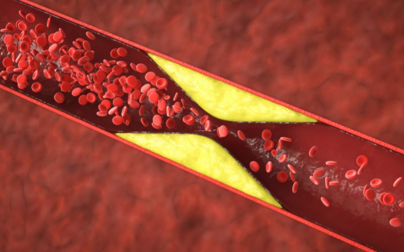 Nguyên nhân trực tiếp gây nhồi máu cơ tim là do động mạch vành