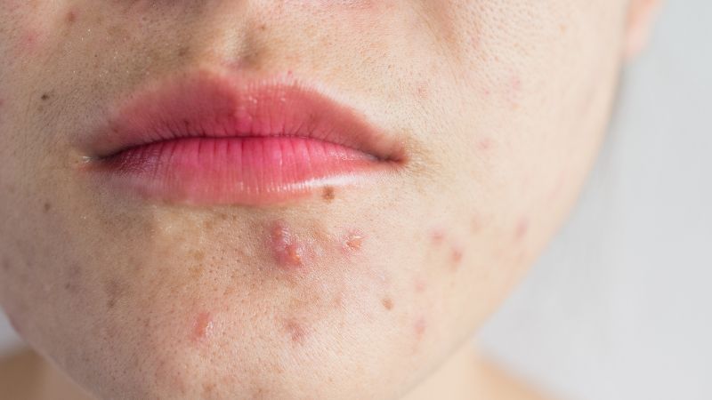 Tác hại của Corticoid trong "kem trộn" khiến da mỏng, dễ đỏ và kích ứng