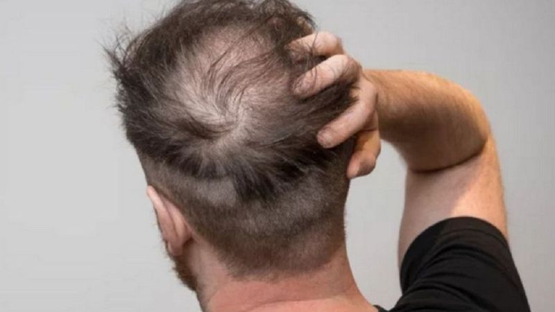 Hói đầu, rụng tóc sớm là dấu hiệu khi lạm dụng Sterioid