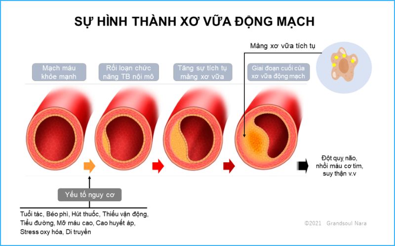 4 Giai đoạn hình thành xơ vữa động mạch