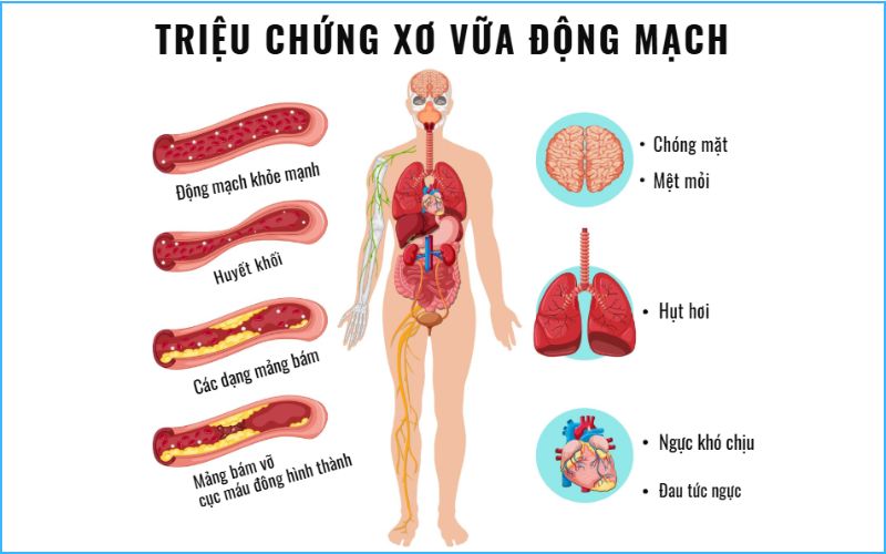 Các triệu chứng xơ vữa động mạch