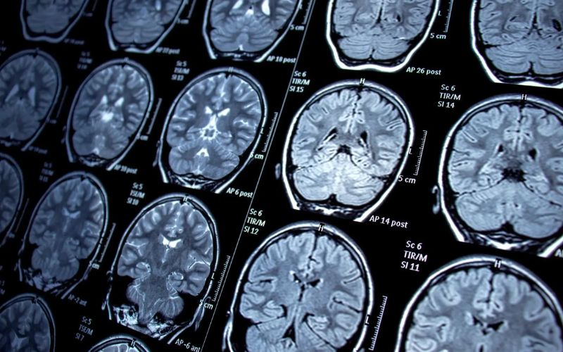 Chụp CT hoặc MRI để chuẩn đoán xơ vữa động mạch