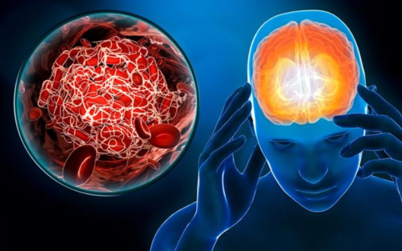 Xơ vữa động mạch có thể dẫn đến đột quỵ não