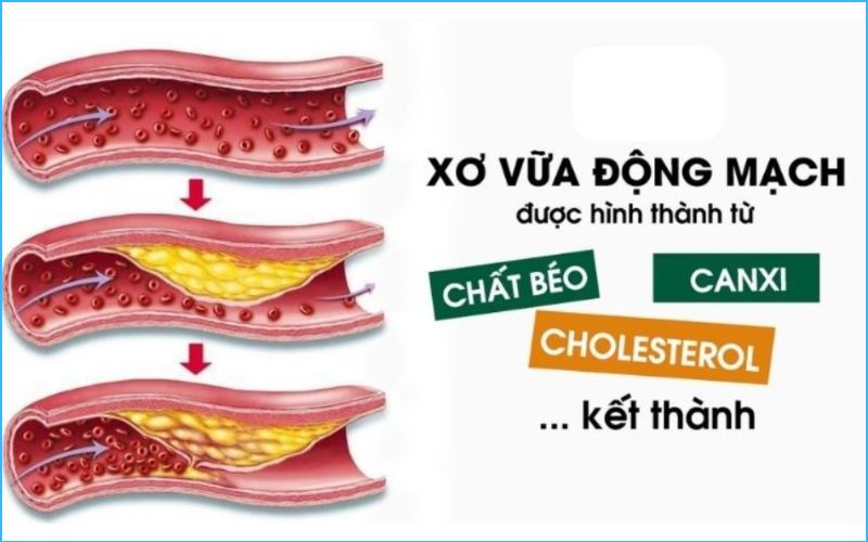 Xơ vữa động mạch là một bệnh lý mạn tính được hình thành từ chất béo và cholesterol kết thành