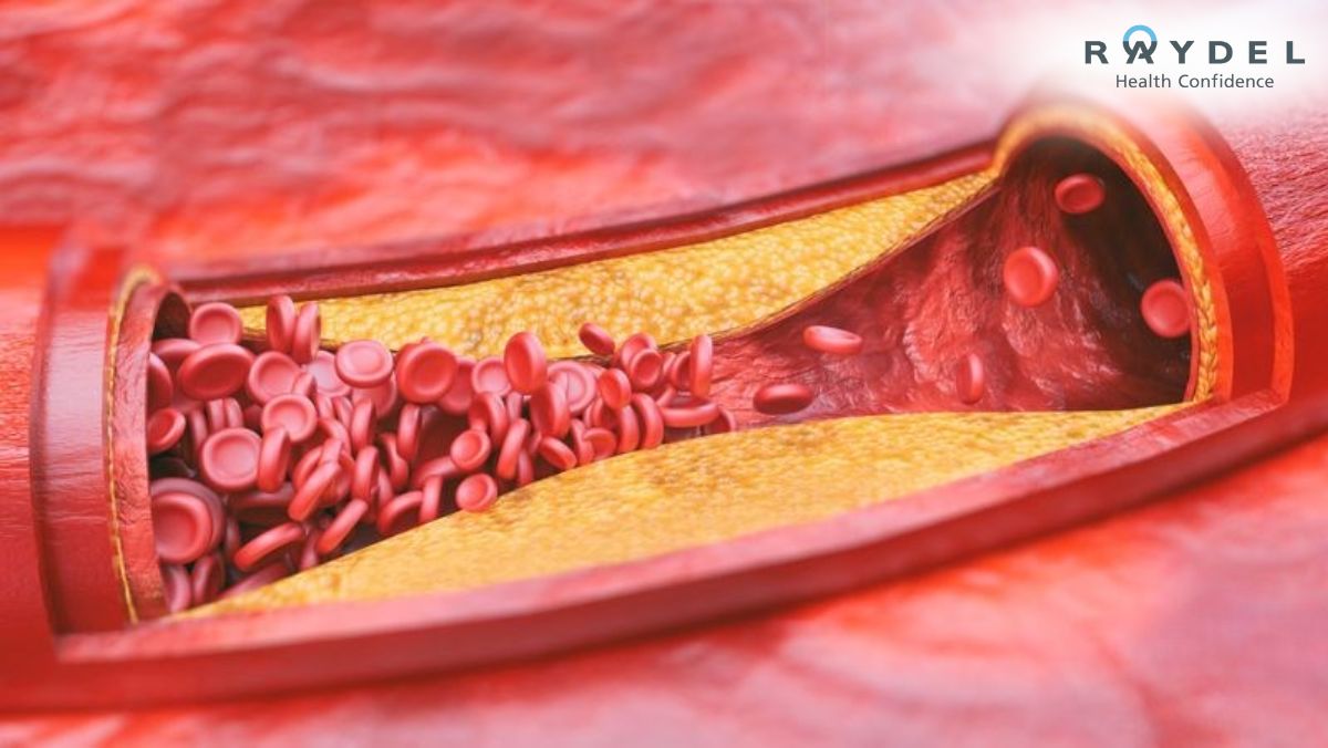 Xơ vữa động mạch: Nguyên nhân, triệu chứng và cách điều trị